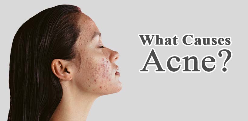 According to Experts These are The Best Acne Products (2023)